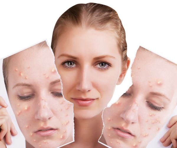 Skin Type